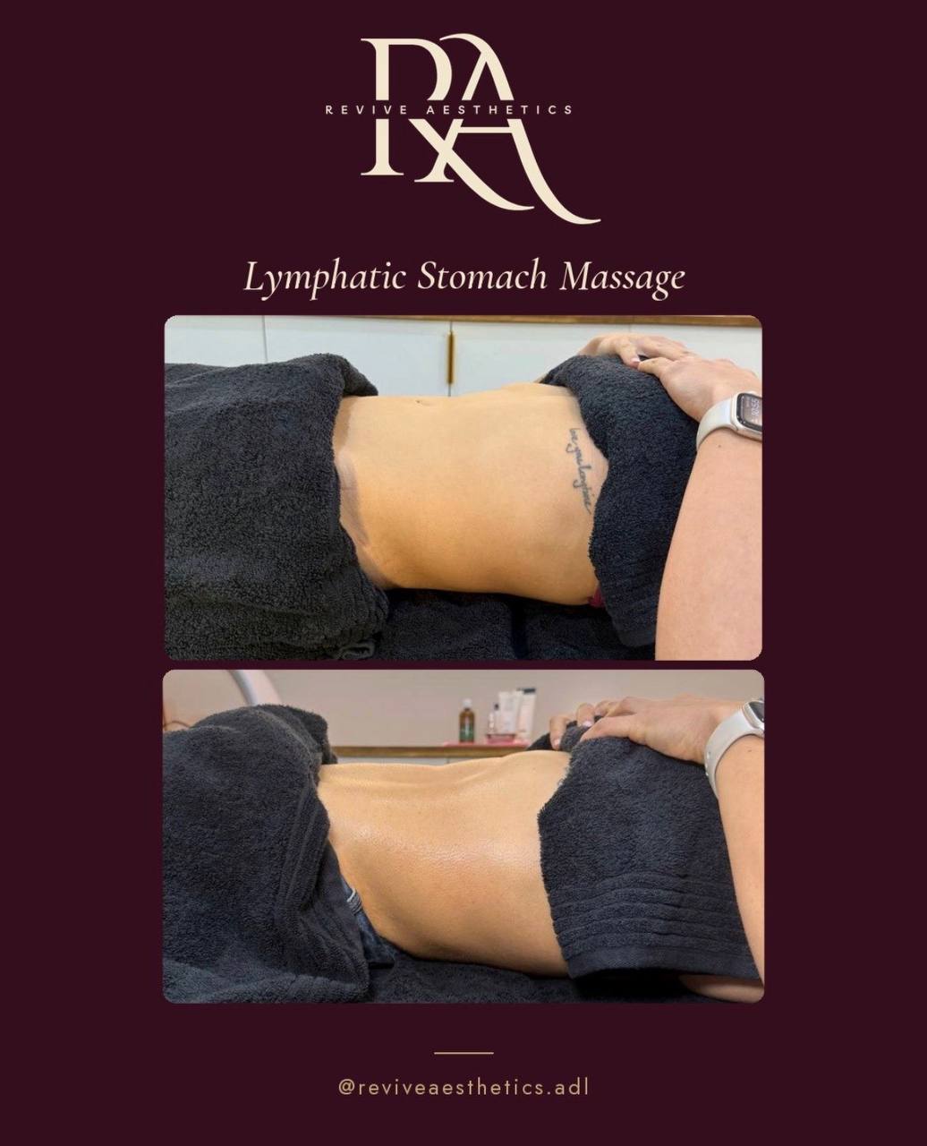 Lymphatic stomach drainage massage result — Revive Aesthetics Adelaide