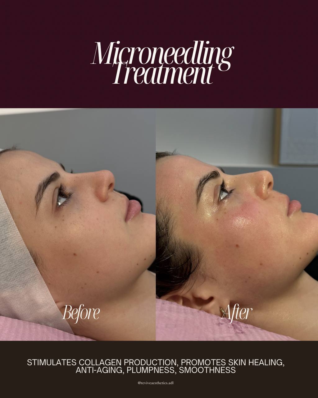 Microneedling before and after result — Revive Aesthetics Adelaide