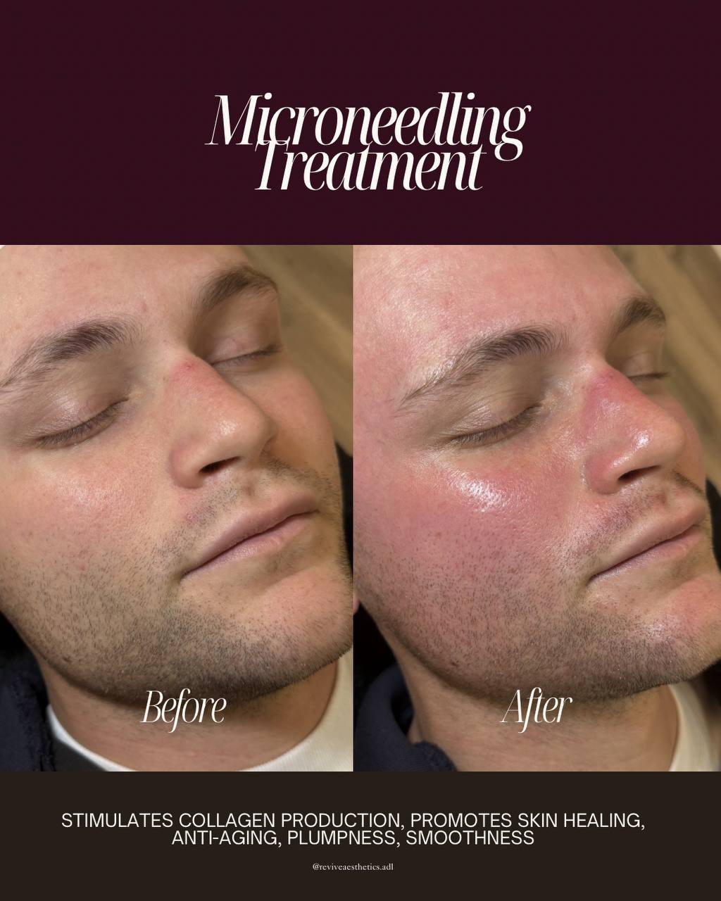 Microneedling before and after result — Revive Aesthetics Adelaide